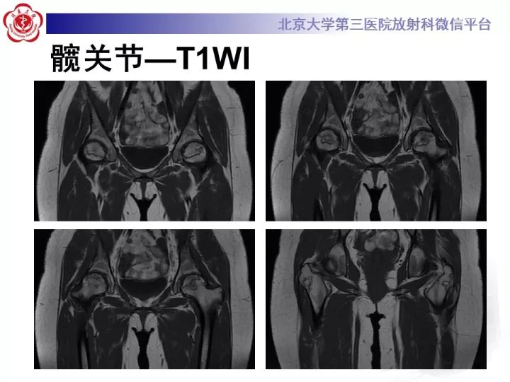 【病例】骨梗死1例MR影像诊断
