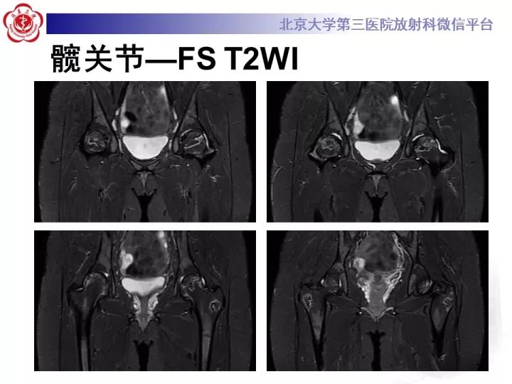 【病例】骨梗死1例MR影像诊断