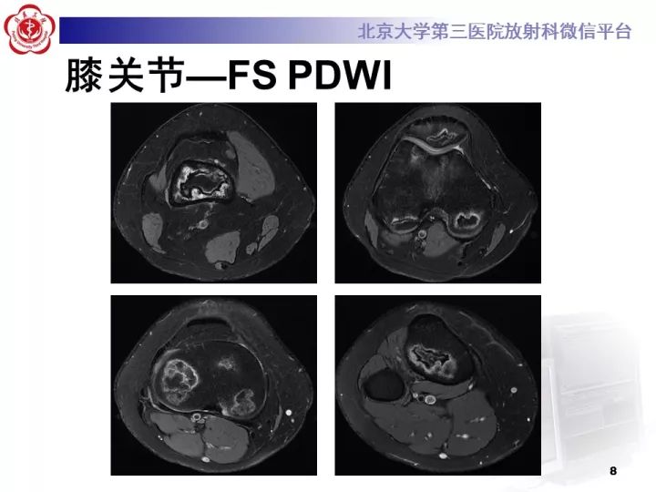 【病例】骨梗死1例MR影像诊断
