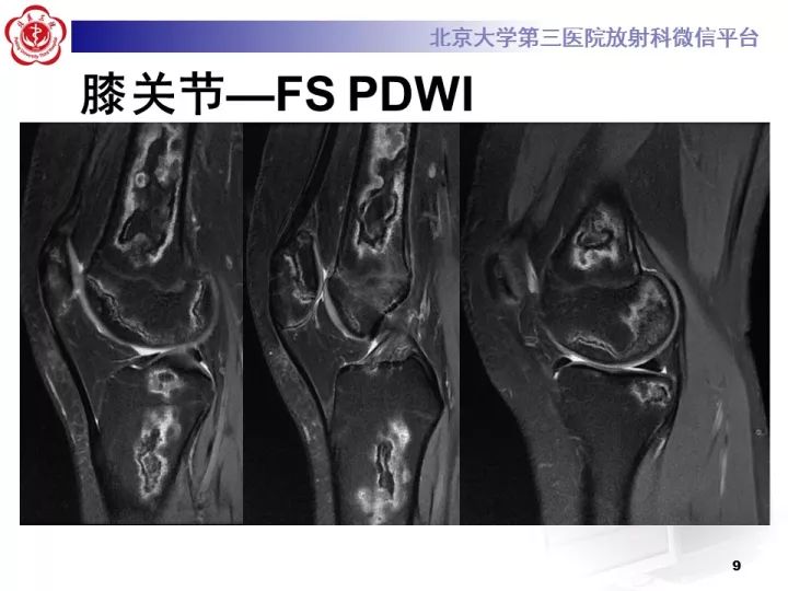 【病例】骨梗死1例MR影像诊断