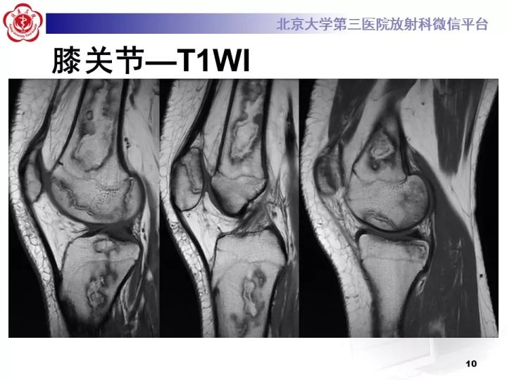 【病例】骨梗死1例MR影像诊断
