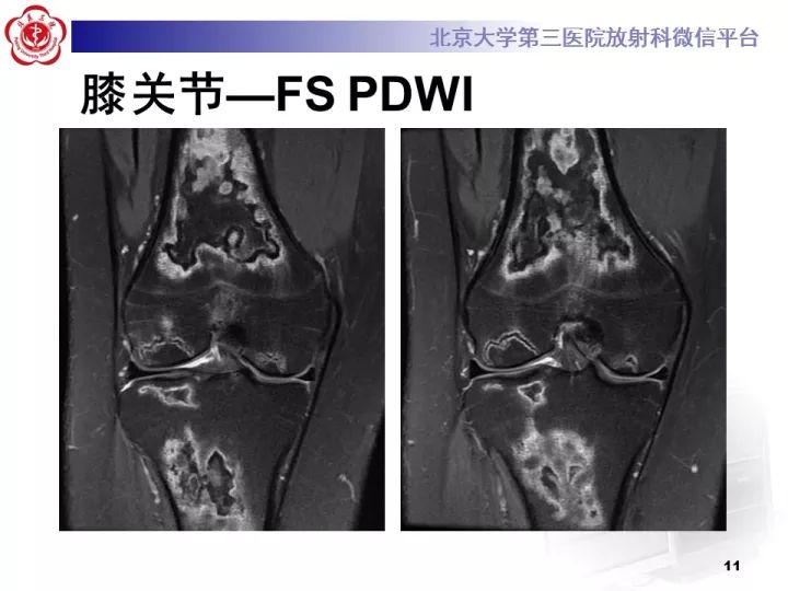 【病例】骨梗死1例MR影像诊断