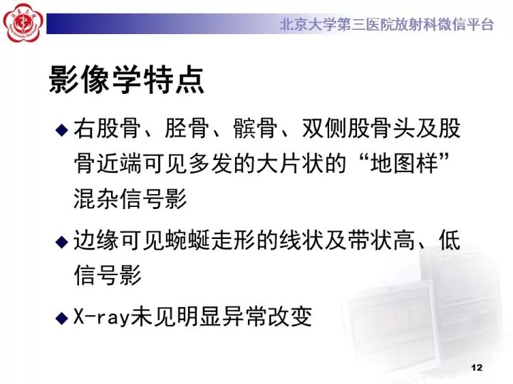 【病例】骨梗死1例MR影像诊断