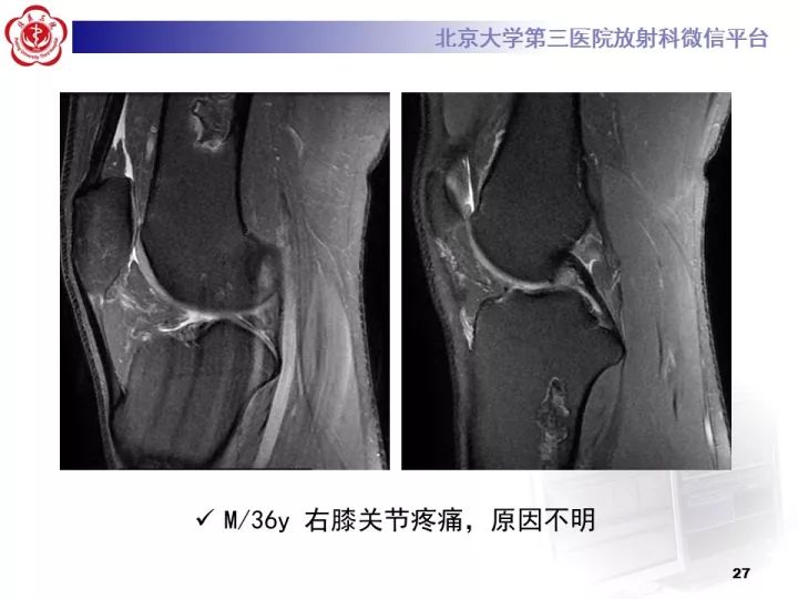 【病例】骨梗死1例MR影像诊断