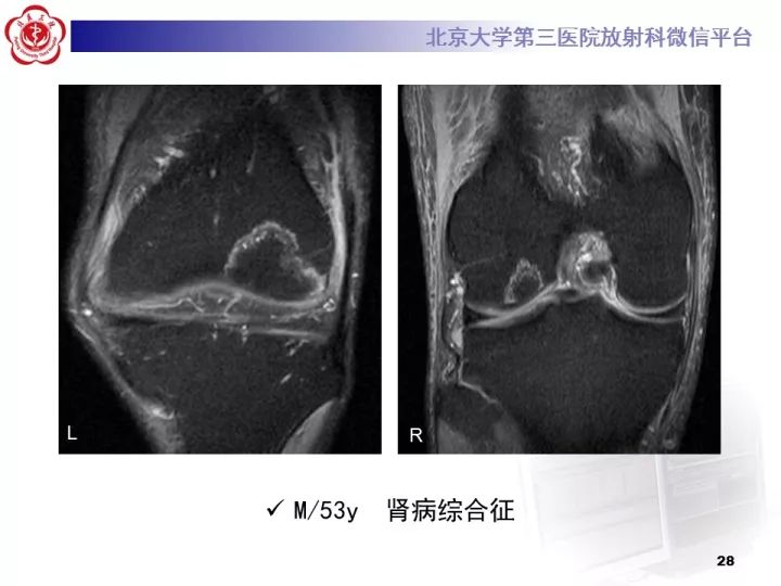 【病例】骨梗死1例MR影像诊断