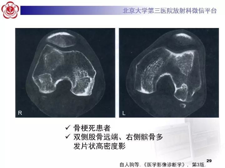 【病例】骨梗死1例MR影像诊断