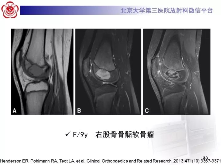 【病例】骨梗死1例MR影像诊断