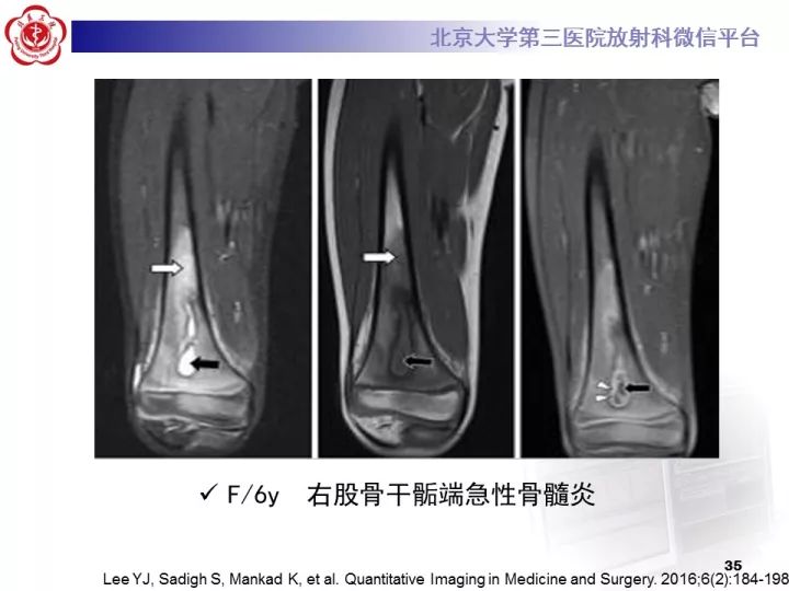 【病例】骨梗死1例MR影像诊断