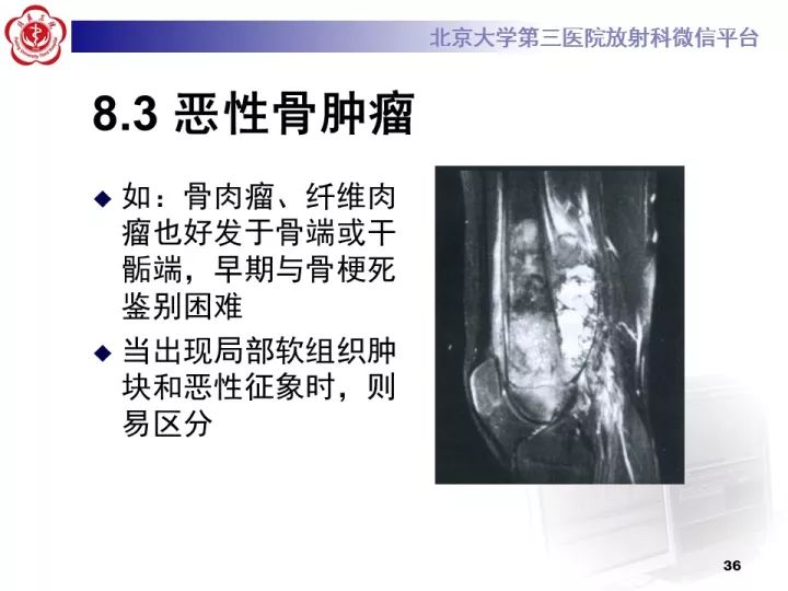 【病例】骨梗死1例MR影像诊断