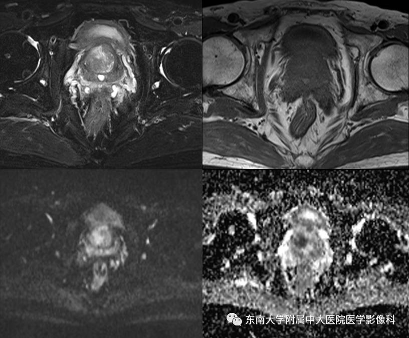 【病例】前列腺癌VS前列腺增生结节VS前列腺脓肿4例MR 【病例】前列腺癌VS前列腺增生结节VS前列腺脓肿4例MR