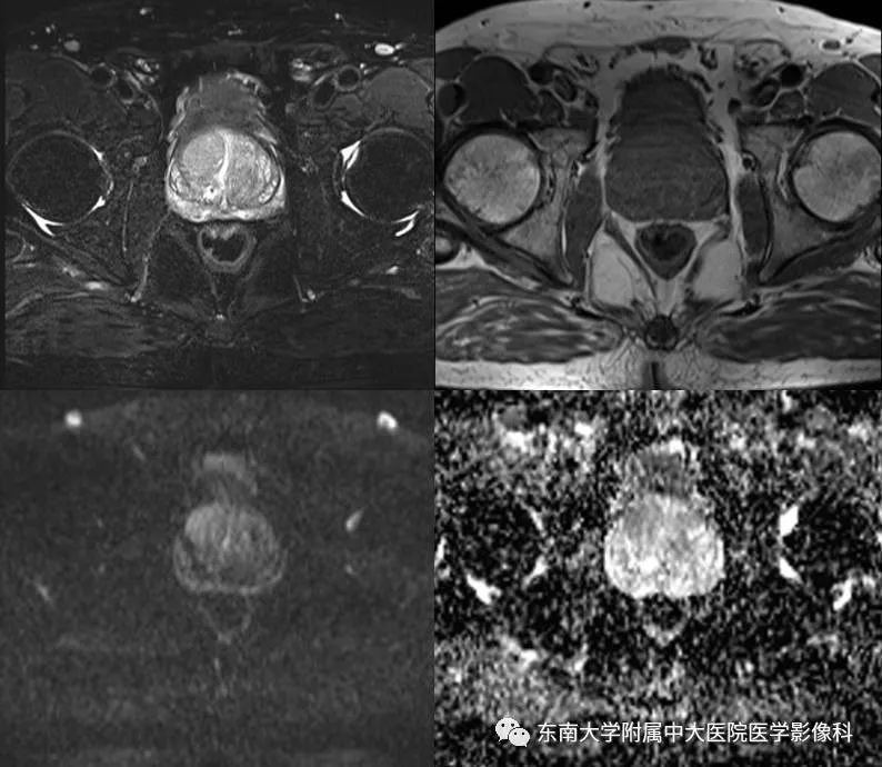 【病例】前列腺癌VS前列腺增生结节VS前列腺脓肿4例MR 【病例】前列腺癌VS前列腺增生结节VS前列腺脓肿4例MR