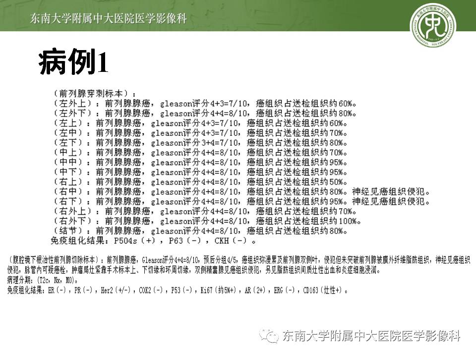 【病例】前列腺癌VS前列腺增生结节VS前列腺脓肿4例MR 【病例】前列腺癌VS前列腺增生结节VS前列腺脓肿4例MR