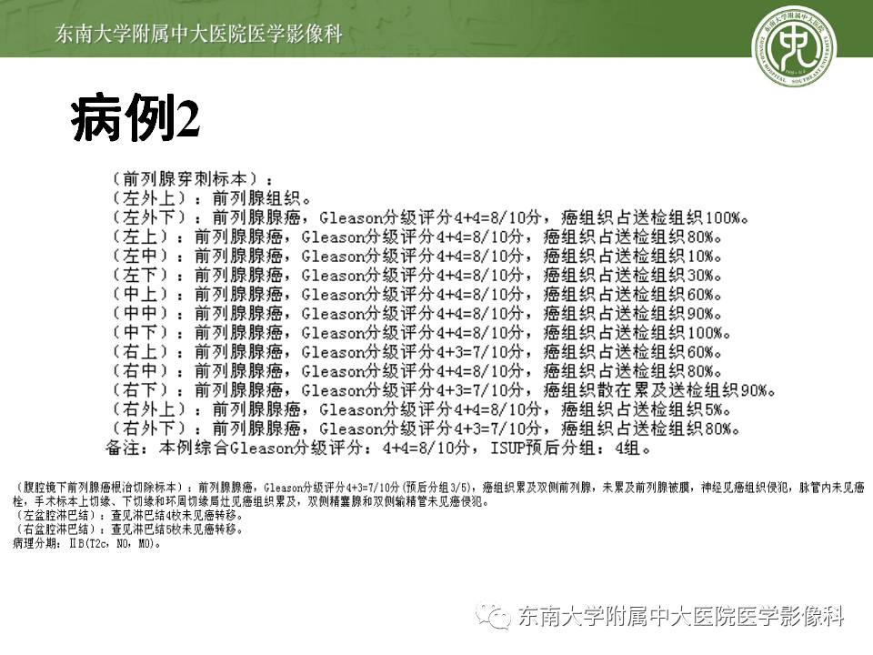 【病例】前列腺癌VS前列腺增生结节VS前列腺脓肿4例MR 【病例】前列腺癌VS前列腺增生结节VS前列腺脓肿4例MR