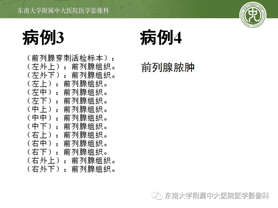 【病例】前列腺癌VS前列腺增生结节VS前列腺脓肿4例MR 【病例】前列腺癌VS前列腺增生结节VS前列腺脓肿4例MR