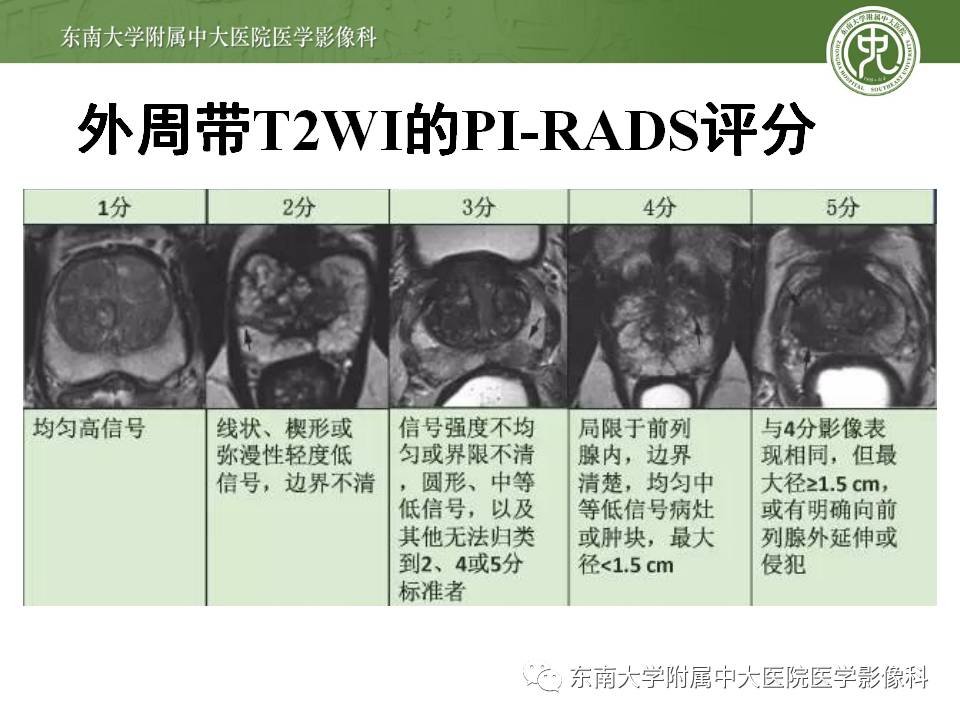 【病例】前列腺癌VS前列腺增生结节VS前列腺脓肿4例MR 【病例】前列腺癌VS前列腺增生结节VS前列腺脓肿4例MR
