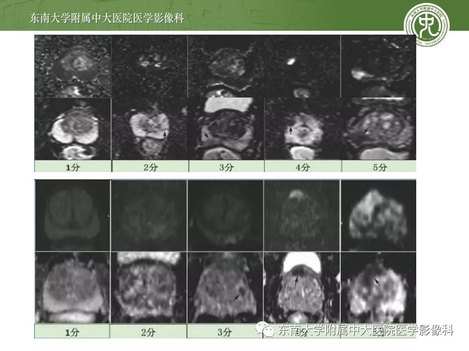 【病例】前列腺癌VS前列腺增生结节VS前列腺脓肿4例MR 【病例】前列腺癌VS前列腺增生结节VS前列腺脓肿4例MR