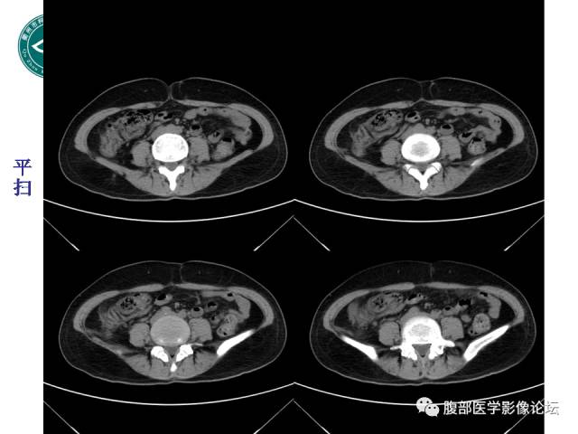 【病例】右附件浆液性囊腺瘤1例CT及MR影像表现