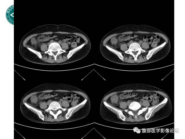 【病例】右附件浆液性囊腺瘤1例CT及MR影像表现