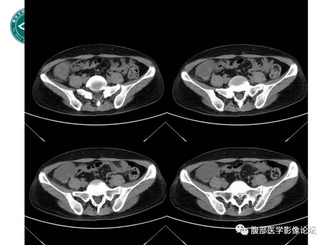 【病例】右附件浆液性囊腺瘤1例CT及MR影像表现