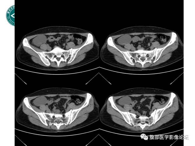 【病例】右附件浆液性囊腺瘤1例CT及MR影像表现