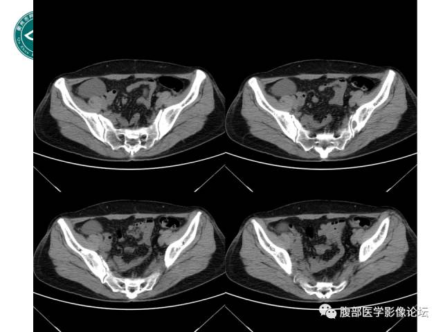 【病例】右附件浆液性囊腺瘤1例CT及MR影像表现
