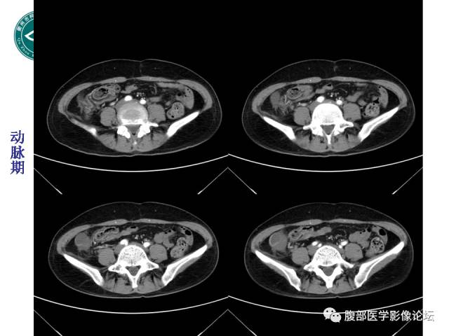 【病例】右附件浆液性囊腺瘤1例CT及MR影像表现
