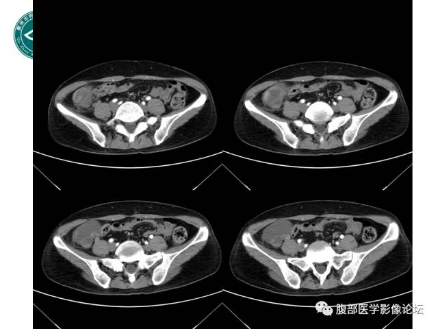 【病例】右附件浆液性囊腺瘤1例CT及MR影像表现