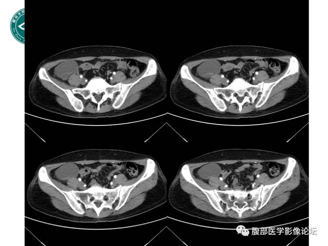 【病例】右附件浆液性囊腺瘤1例CT及MR影像表现