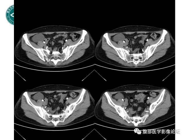 【病例】右附件浆液性囊腺瘤1例CT及MR影像表现