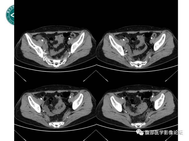 【病例】右附件浆液性囊腺瘤1例CT及MR影像表现