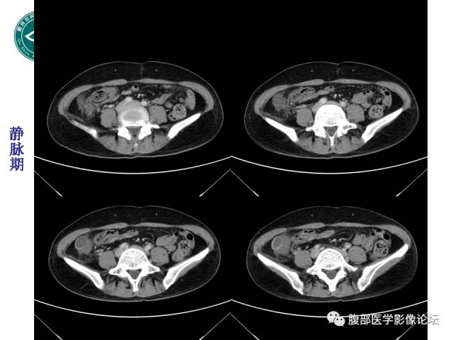 【病例】右附件浆液性囊腺瘤1例CT及MR影像表现