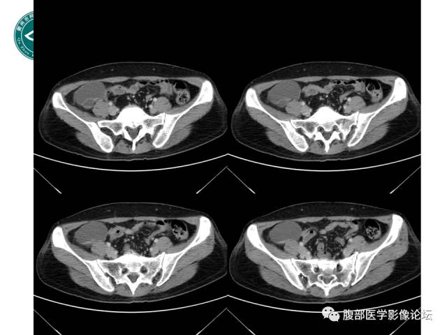 【病例】右附件浆液性囊腺瘤1例CT及MR影像表现