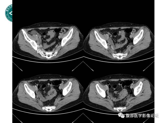 【病例】右附件浆液性囊腺瘤1例CT及MR影像表现