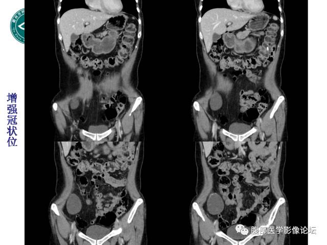 【病例】右附件浆液性囊腺瘤1例CT及MR影像表现