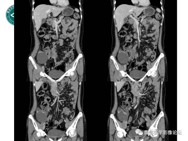 【病例】右附件浆液性囊腺瘤1例CT及MR影像表现