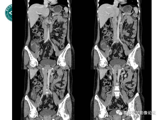 【病例】右附件浆液性囊腺瘤1例CT及MR影像表现