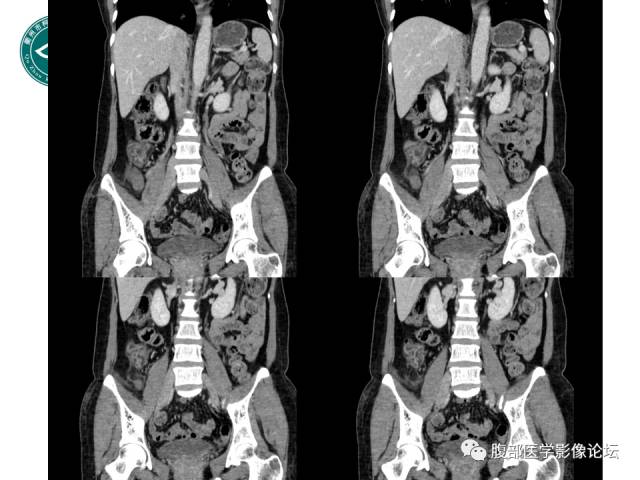 【病例】右附件浆液性囊腺瘤1例CT及MR影像表现