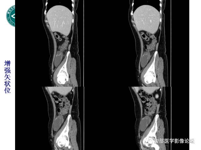 【病例】右附件浆液性囊腺瘤1例CT及MR影像表现