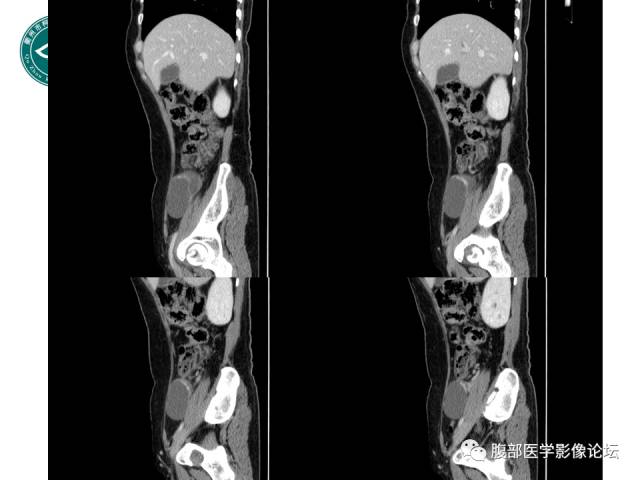 【病例】右附件浆液性囊腺瘤1例CT及MR影像表现