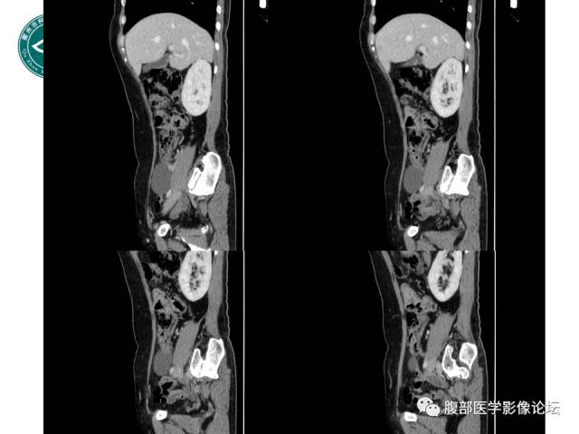 【病例】右附件浆液性囊腺瘤1例CT及MR影像表现