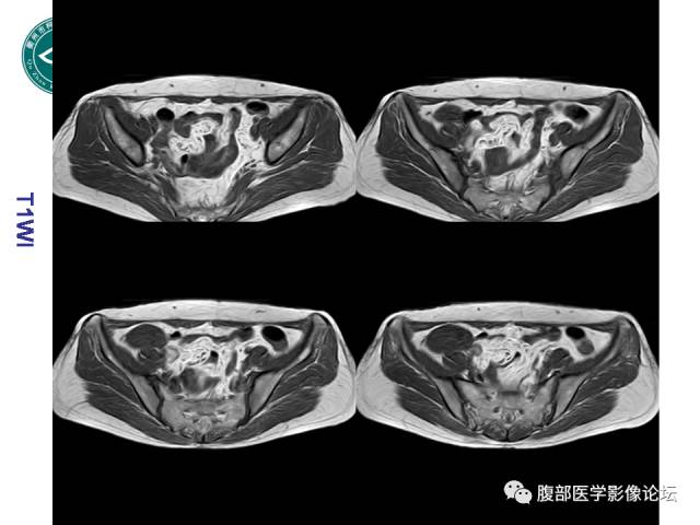 【病例】右附件浆液性囊腺瘤1例CT及MR影像表现