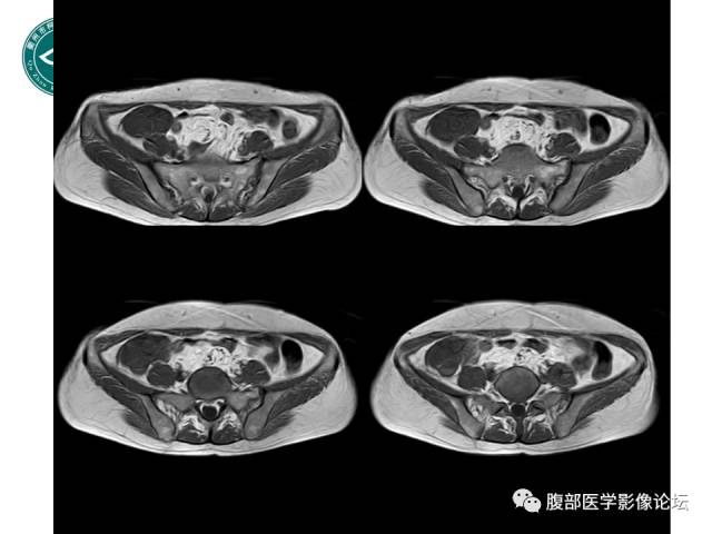 【病例】右附件浆液性囊腺瘤1例CT及MR影像表现