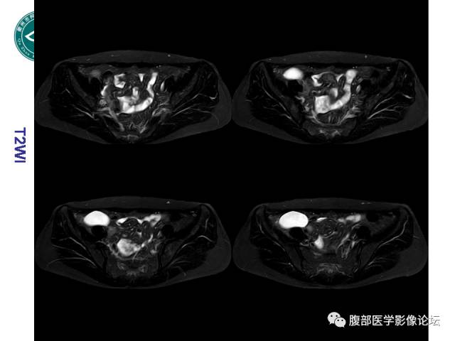 【病例】右附件浆液性囊腺瘤1例CT及MR影像表现
