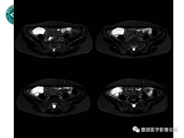 【病例】右附件浆液性囊腺瘤1例CT及MR影像表现
