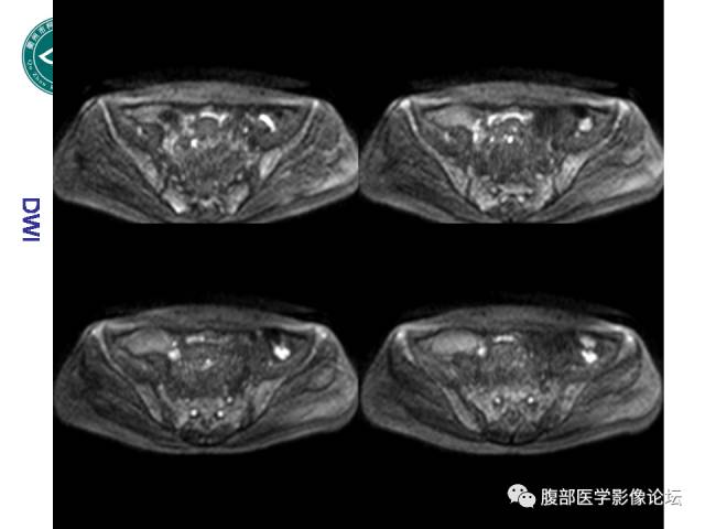 【病例】右附件浆液性囊腺瘤1例CT及MR影像表现