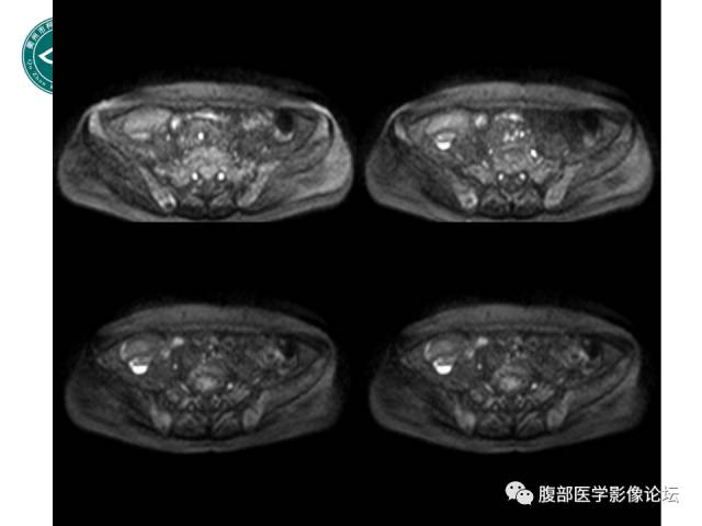 【病例】右附件浆液性囊腺瘤1例CT及MR影像表现