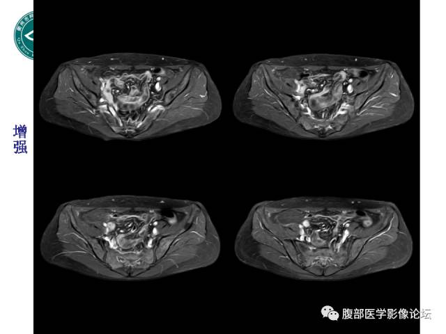【病例】右附件浆液性囊腺瘤1例CT及MR影像表现