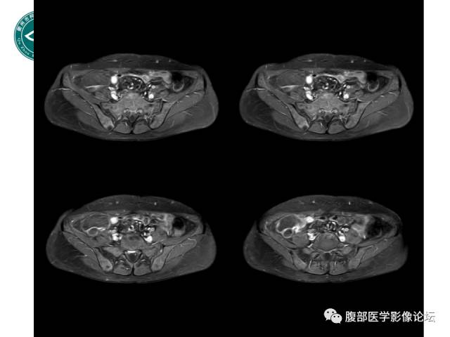 【病例】右附件浆液性囊腺瘤1例CT及MR影像表现