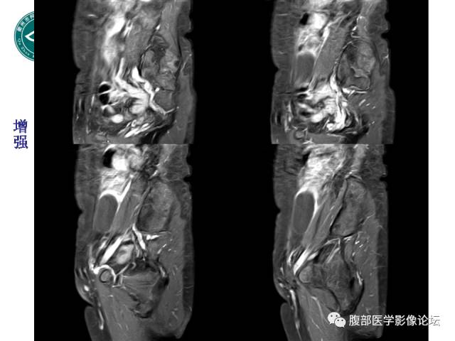 【病例】右附件浆液性囊腺瘤1例CT及MR影像表现