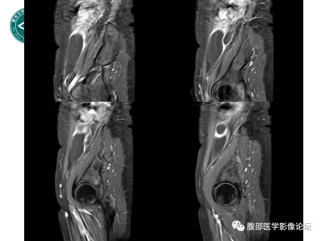 【病例】右附件浆液性囊腺瘤1例CT及MR影像表现